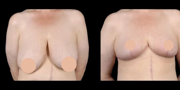 Best Breast Reduction Surgeon in dubai: How to Choose the Right One